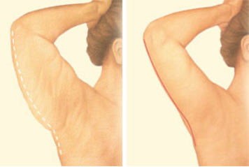 Arm Lift