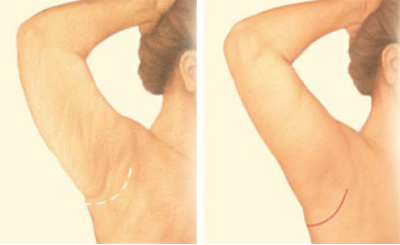 Arm Lift