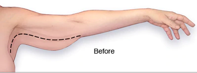 Arm lift