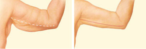 Arm Lift