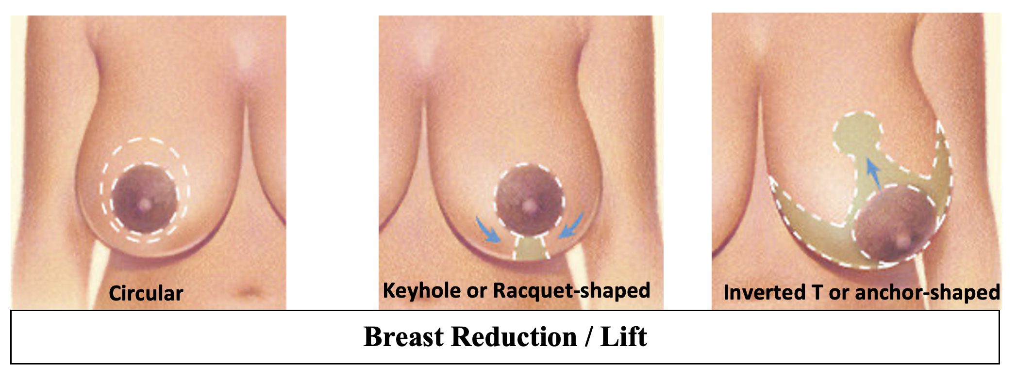 Breast