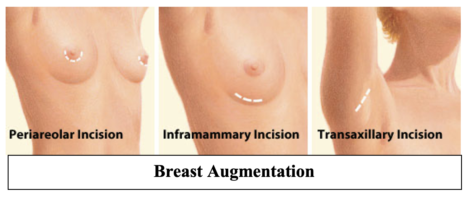 Breast