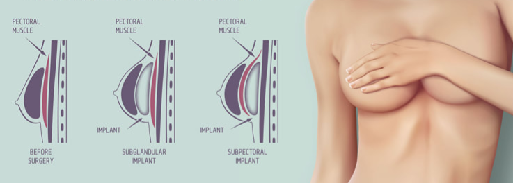 Breast