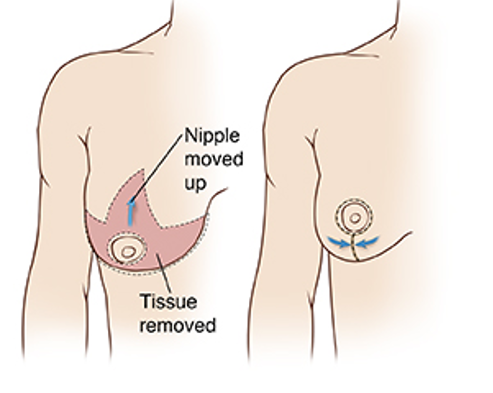 Breast