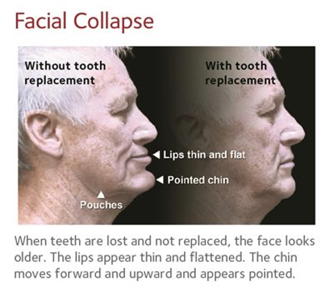 Dental Bridge
