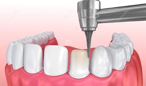Dental Veneers
