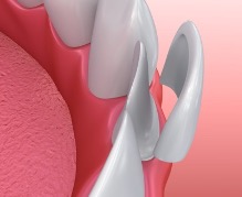 Dental Veneers