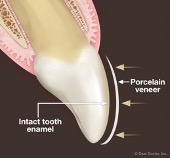 Veneers