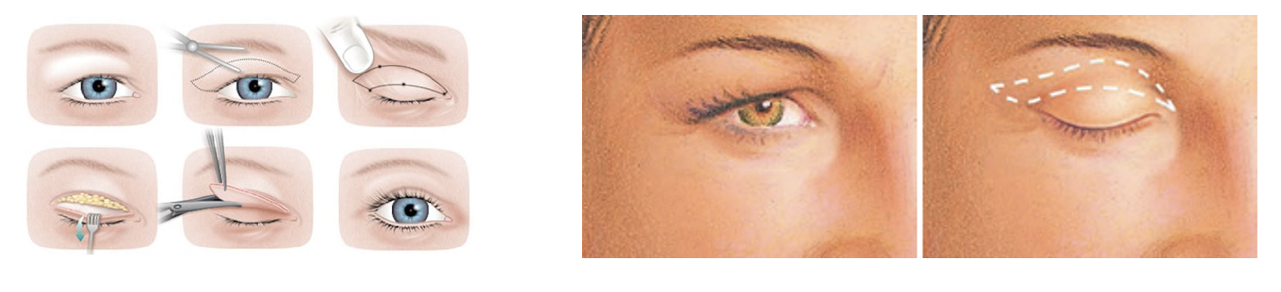 Blepharoplasty (Eyelid Surgery)