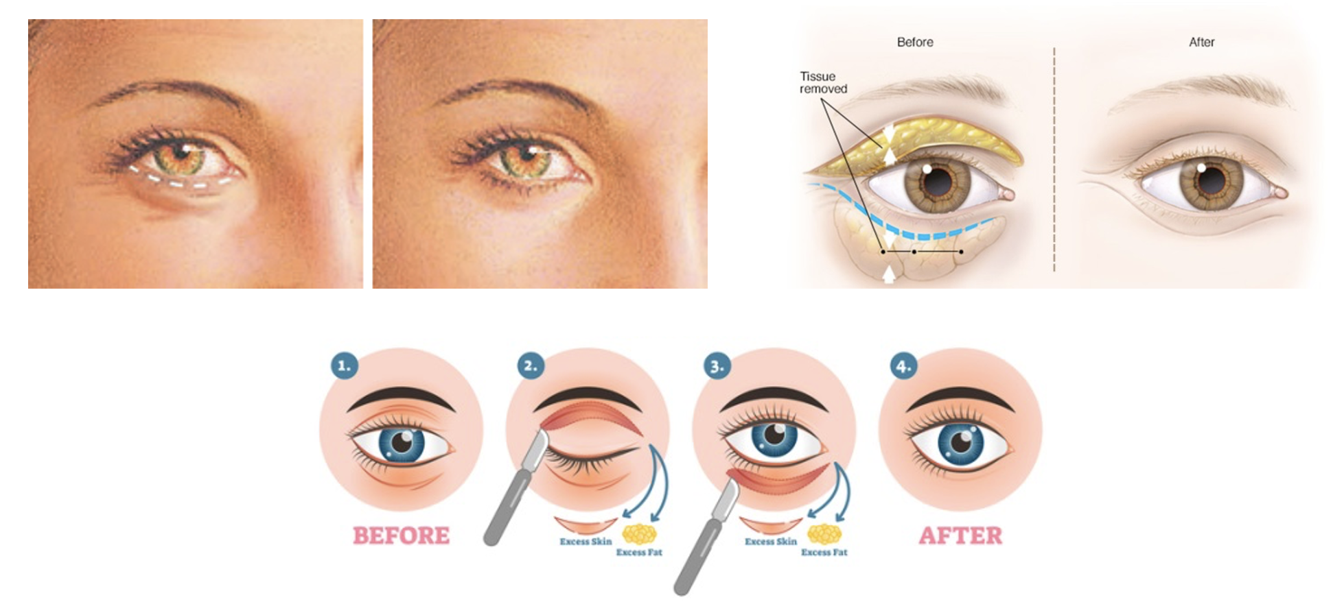 Eyelid Surgery