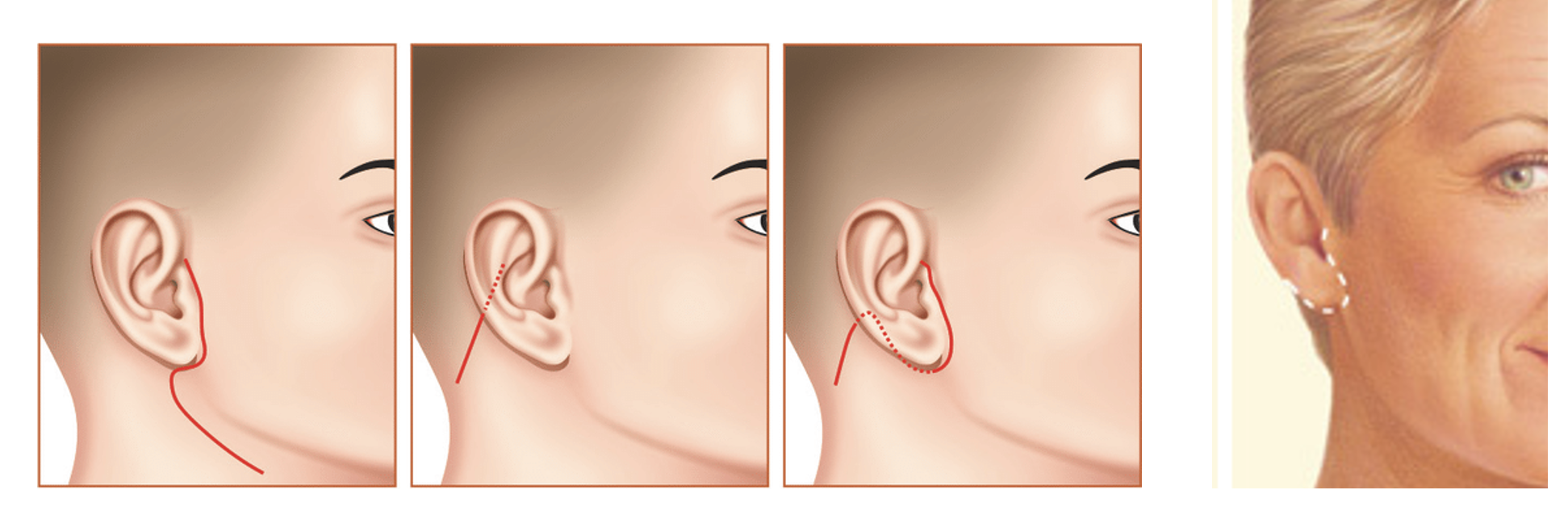 Facelift