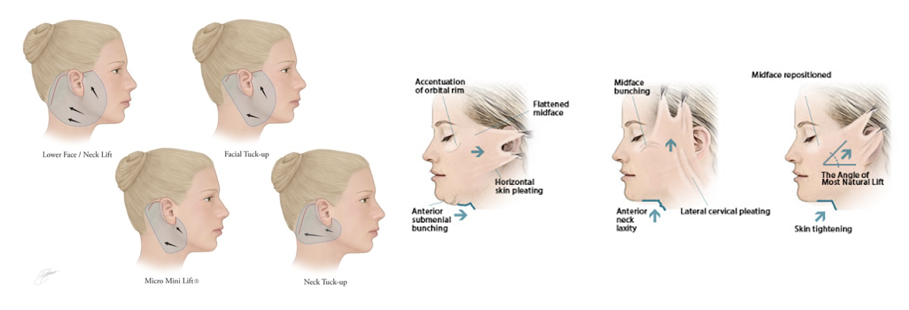 Facelift