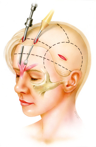 Facelift