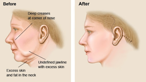 Facelift