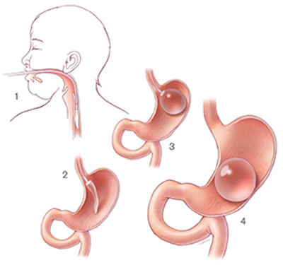 Gastric Balloon
