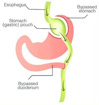 Gastric Bypass