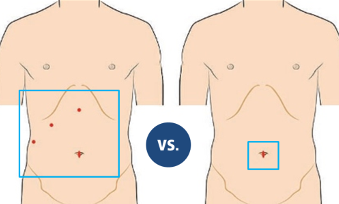 Gastric Sleeve