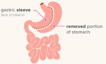 Gastric Sleeve