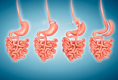 Gastric Sleeve