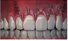 Gums