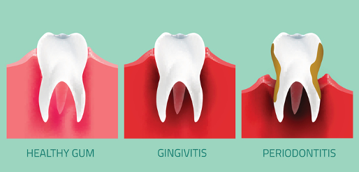 Gums