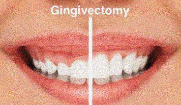 Gums