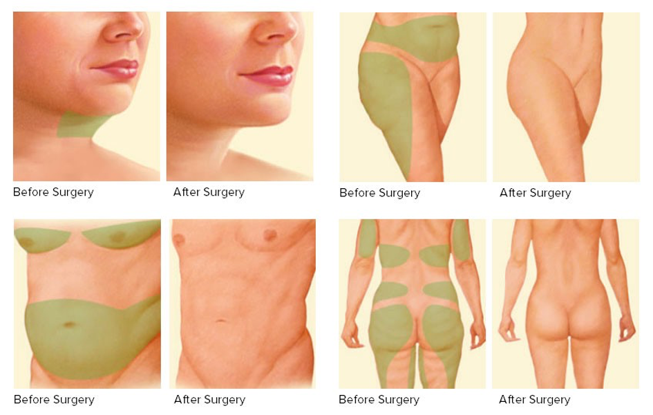 Liposuction