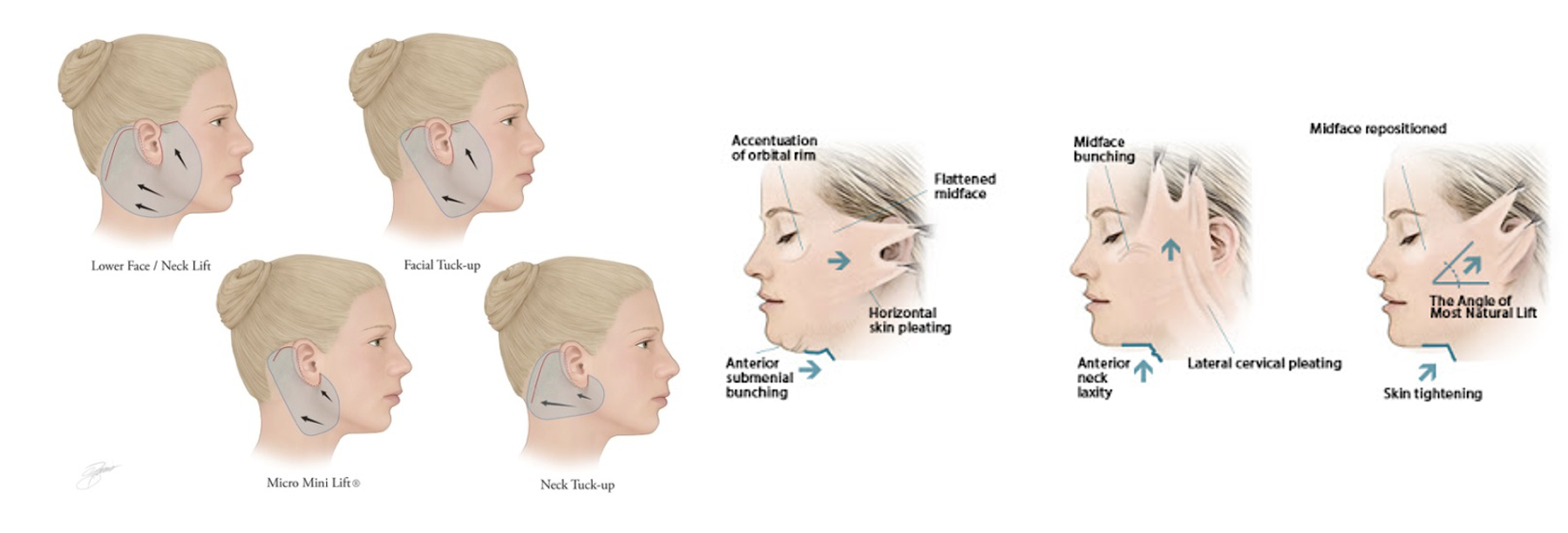 Neck Lift