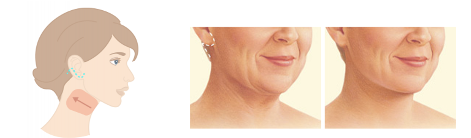 Neck Lift