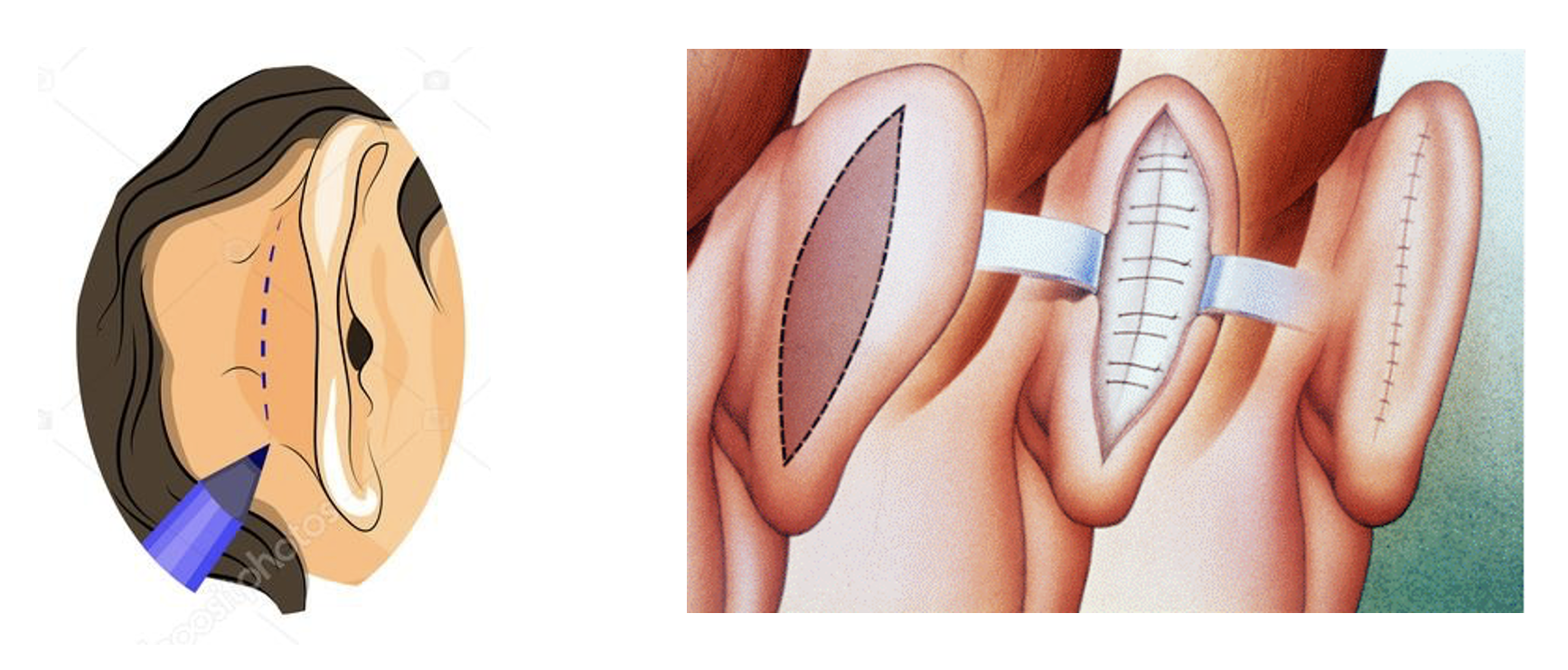 Ear Reconstruction (Otoplasty)