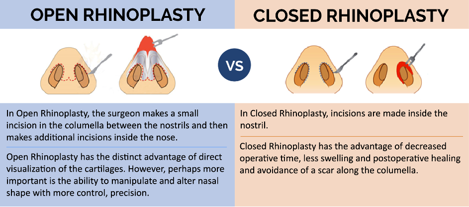 Rhinoplasty