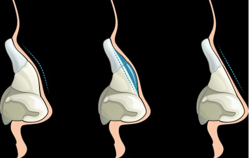 Rhinoplasty