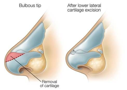 Rhinoplasty
