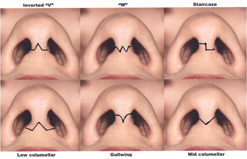 Rhinoplasty