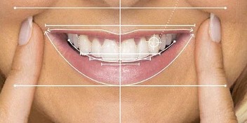 Smile Design