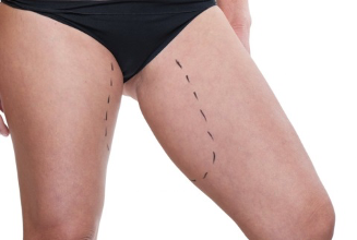 Thigh lift