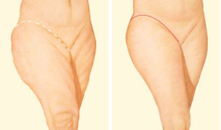 Thigh lift