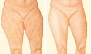Thigh lift