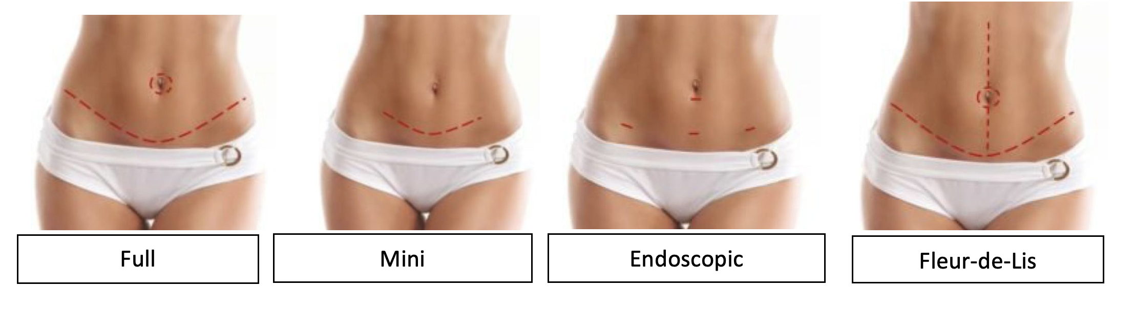 Tummy Tuck