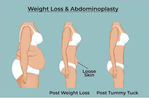 Tummy Tuck (abdominoplasty)