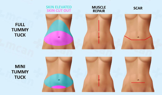 Tummy Tuck
